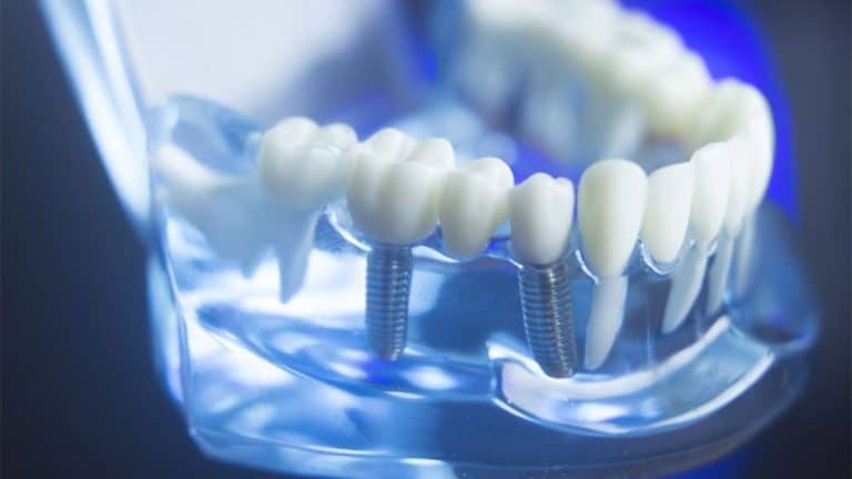 best full-mouth dental implants in Denver