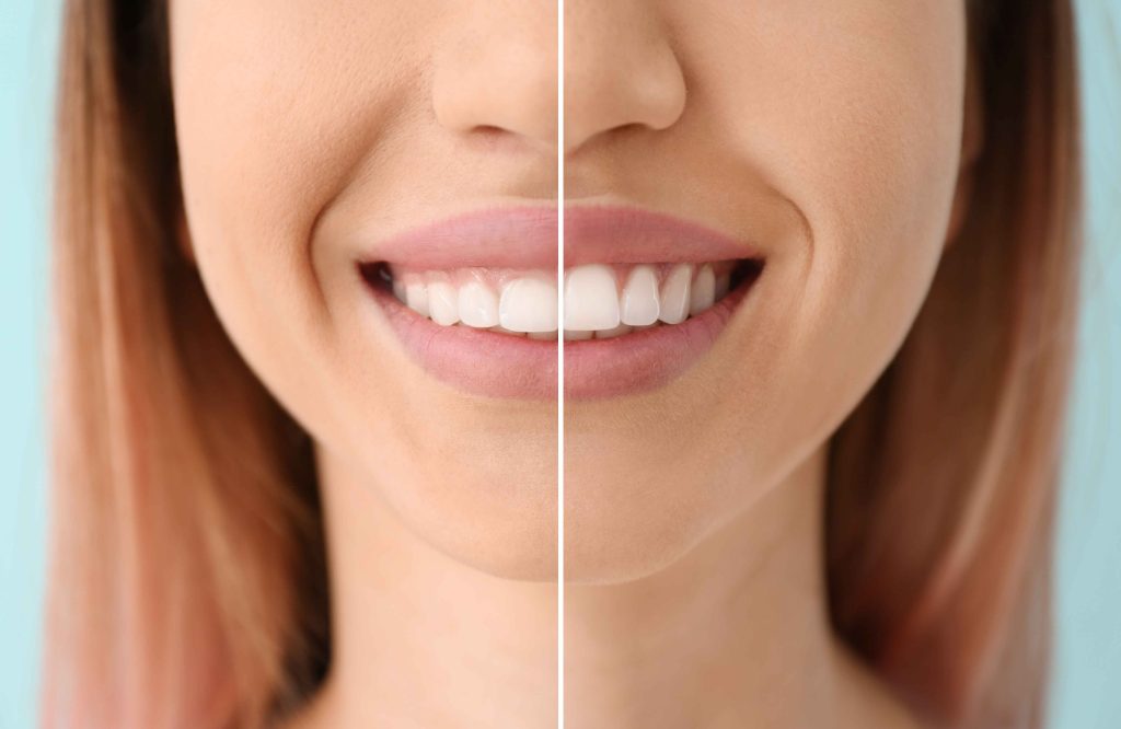 Aesthetic Dentistry Vs Cosmetic Dentistry