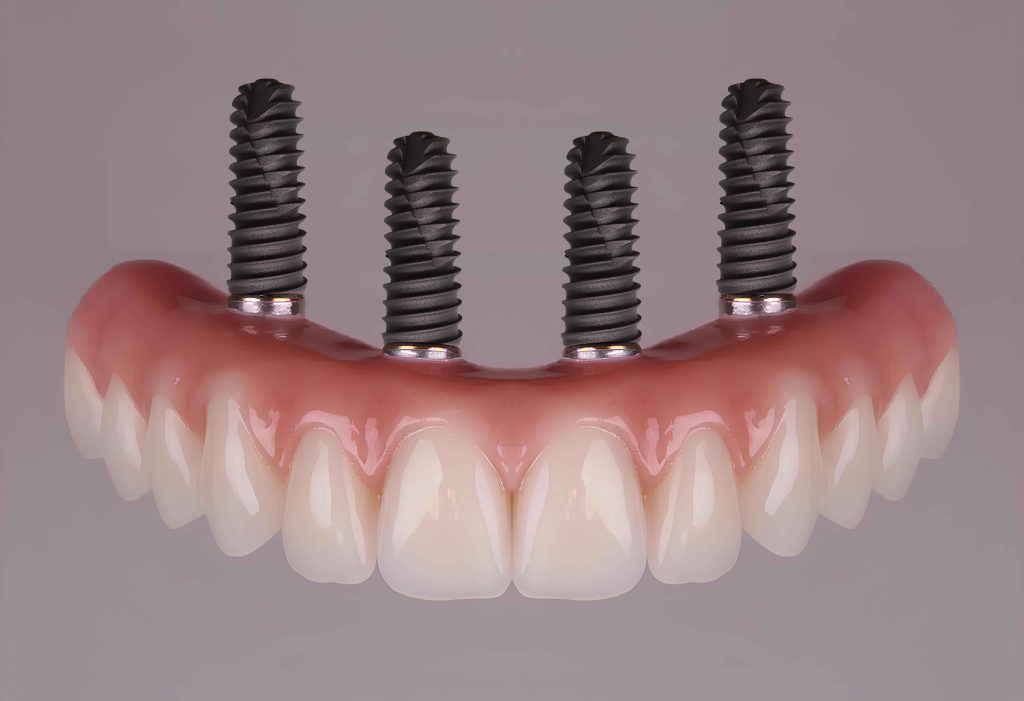 full arch dental implants in Cherry Creek