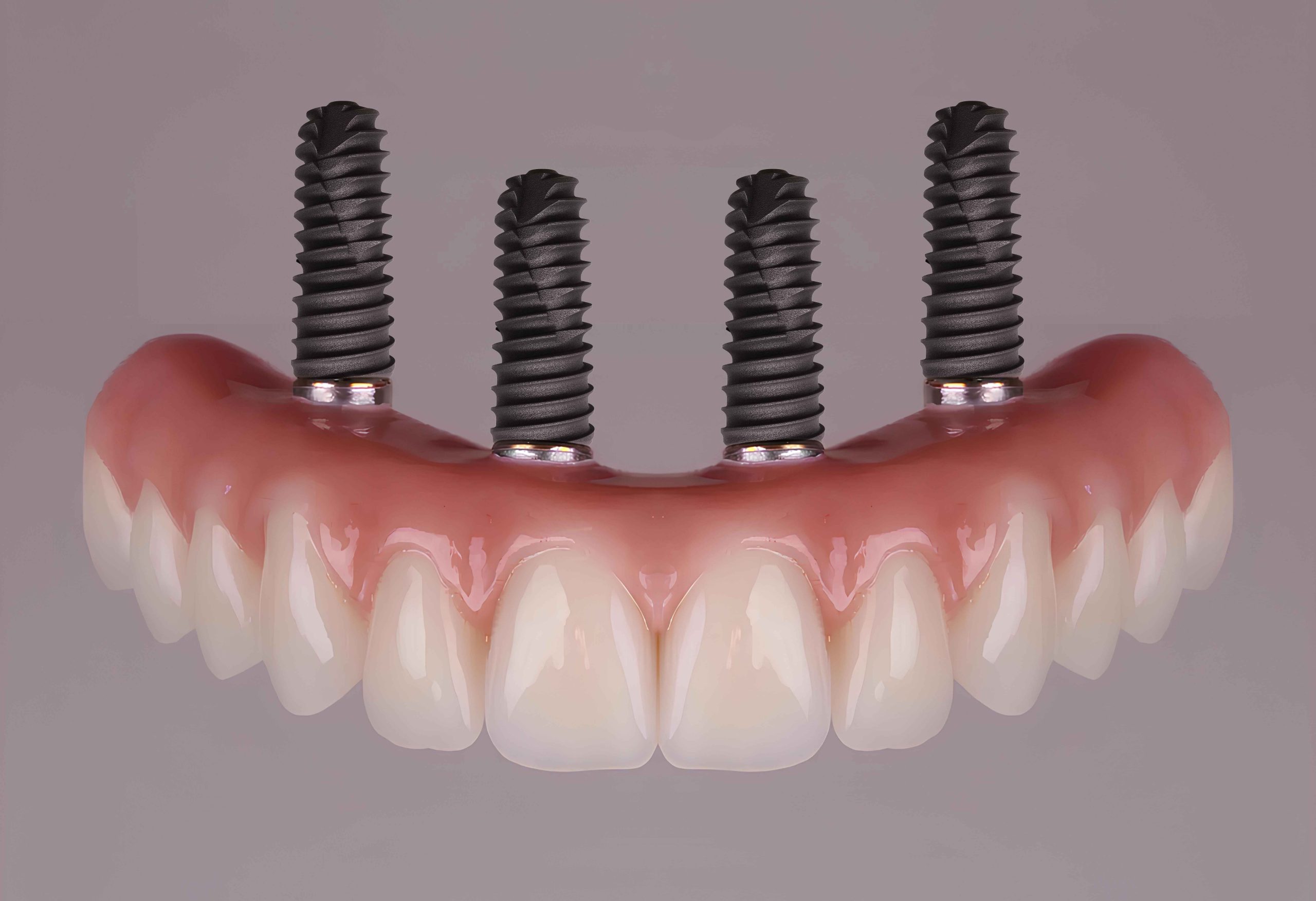 full arch dental implants in Cherry Creek