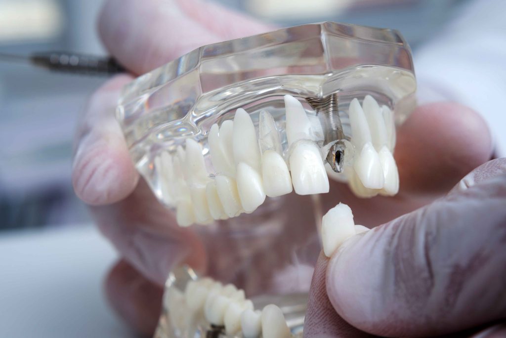 Single-piece dental implants 
