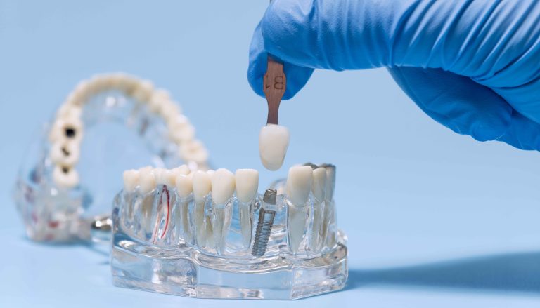 single-piece dental implants