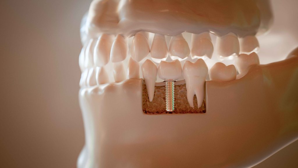 Dental implants in Denver