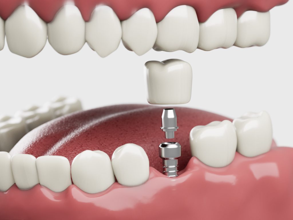 Dental Implants in Denver