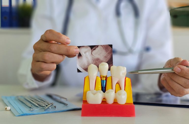 dental implants