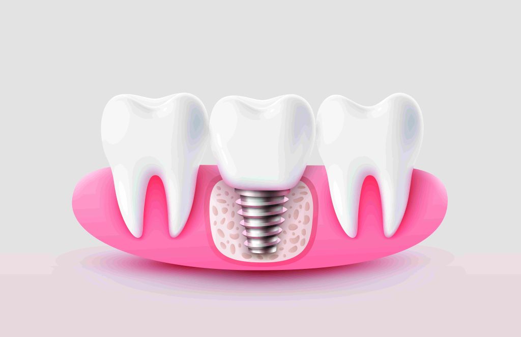 dental implants