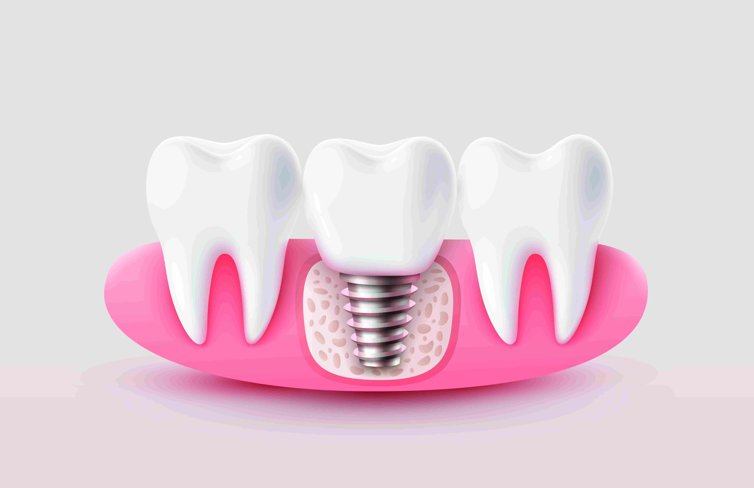dental implants