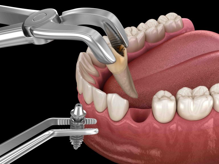 single piece dental implants