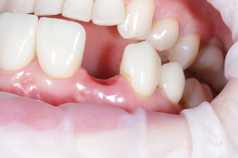 Missing Teeth
