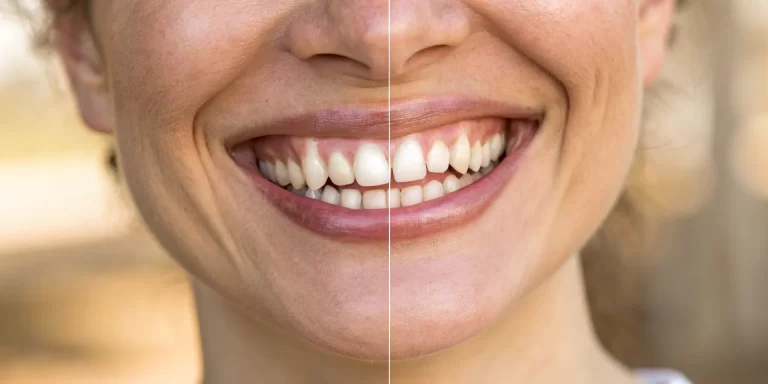 A patient's smile before and after treatment with full arch dental implants.