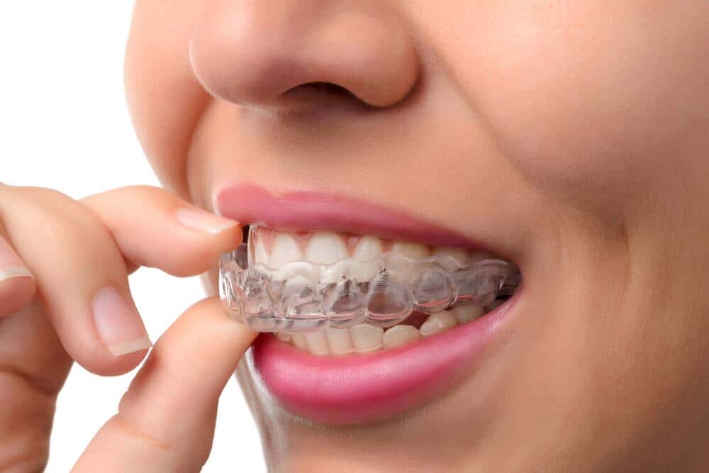 Affordable Invisalign Near Me - DICC Colorado