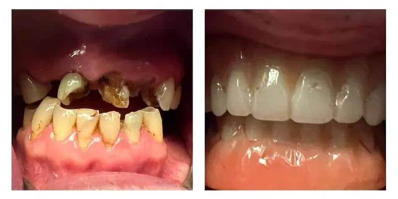 Affordable Dentures in Denver - DIC Colorado