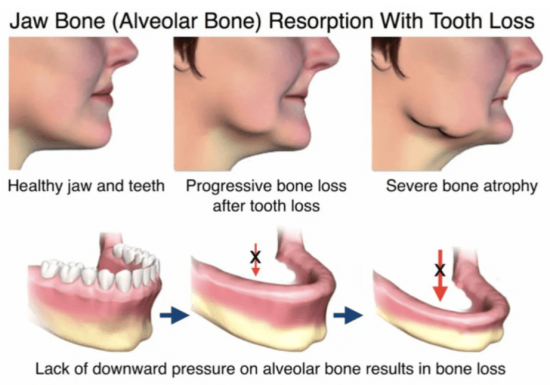 implant-bone-mouth