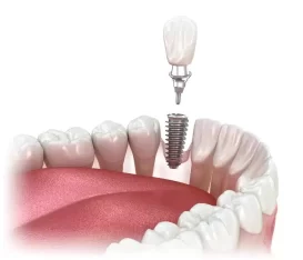 single-dental-implant-21