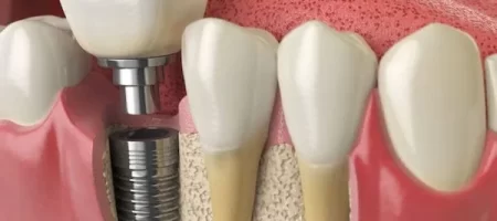 Single Tooth Implant