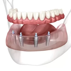 snap-on-dentures-21