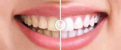 Teeth whitening, before and after