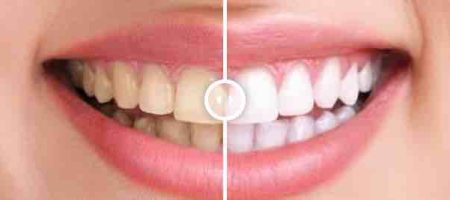 Teeth whitening, before and after